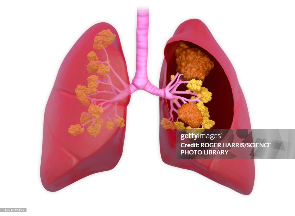 Lung cancer, illustration