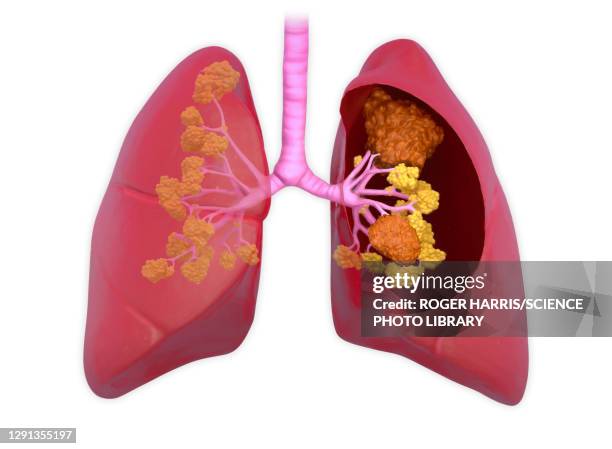 lung cancer, illustration - emphysema stock illustrations