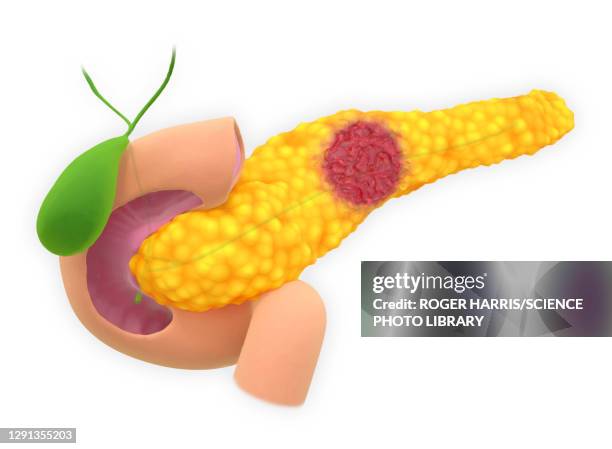 pancreatic neuroendocrine tumour, illustration - tumour stock illustrations