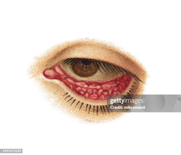 Trachom Trachoma Photos and Premium High Res Pictures - Getty Images