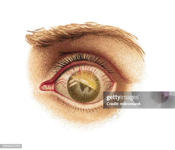 old engraved illustration of eye infections and diseases,  corneal opacity (pannus), developed after granular eye inflammation - ulcer stock-fotos und bilder