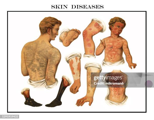 old engraved illustration of skin diseases - eczema child stock-fotos und bilder