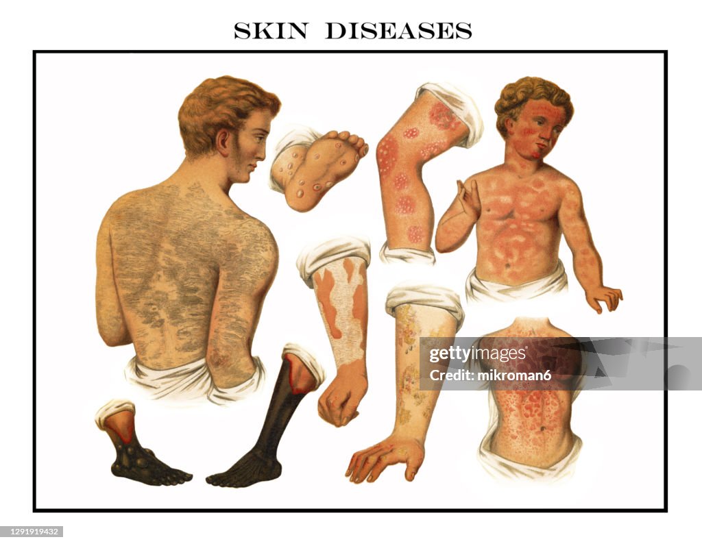 Old engraved illustration of skin diseases