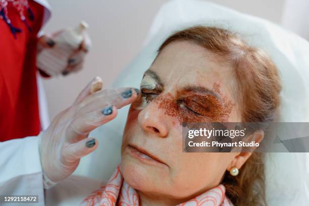 cystische laesies, hyperpigmentatie, palpebrale ptose, palpebrarum, plexr apparaat, xanthelasma, blepharoplasty - hyperpigmentation stockfoto's en -beelden