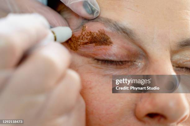 cystische laesies, hyperpigmentatie, palpebrale ptose, palpebrarum, plexr apparaat, xanthelasma, blepharoplasty - hyperpigmentation stockfoto's en -beelden