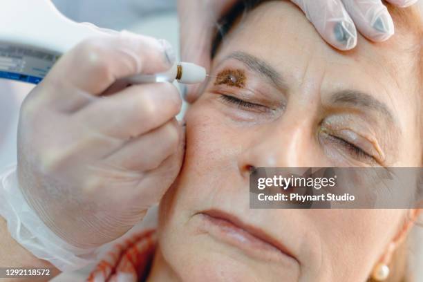 cystic lesions, hyperpigmentation, palpebral ptosis, palpebrarum, plexr device, xanthelasma, blepharoplasty - hyperpigmentation stock pictures, royalty-free photos & images