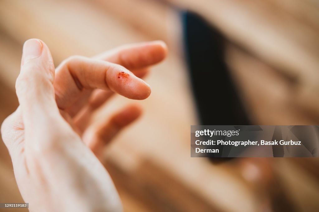 Accidental knife cut