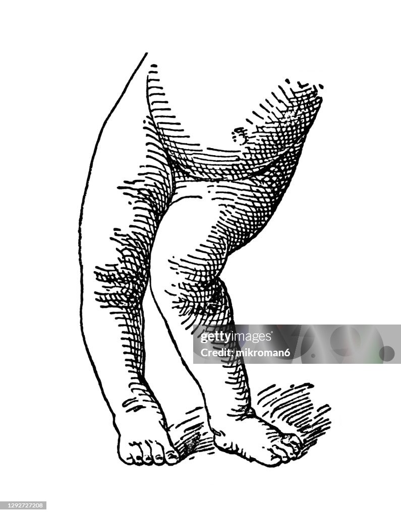 A Child With Rickets Old Engraved Illustration Of Various Types Of Defects Caused By Rickets ...