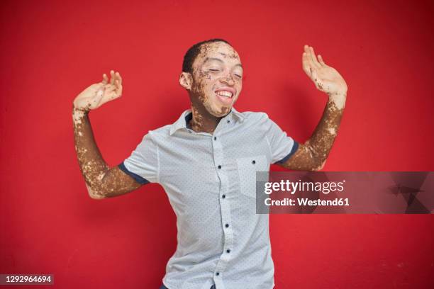 young man with vitiligo dancing in front of a red wall - vitiligo stock pictures, royalty-free photos & images