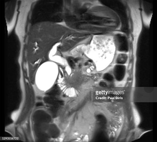 mri upper abdomen coronal plane t2 technique for finding pancreatic invasive adenocarcinoma tumor - abdomen scan stock pictures, royalty-free photos & images