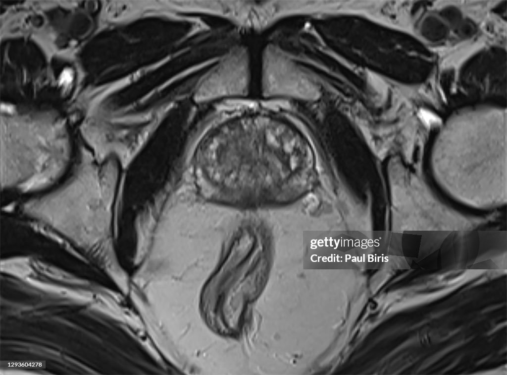 Prostatic Sector Mri Magnetic Resonance Imaging Of Benign Prostatic Hyperplasia Mri Scan ...