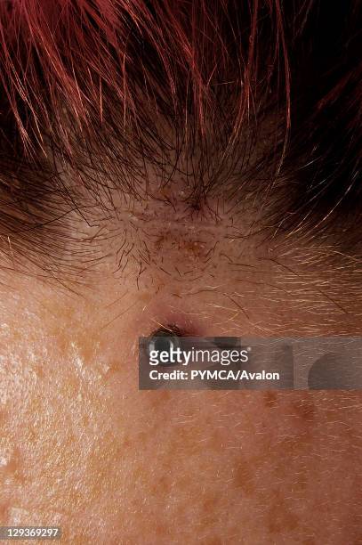 Close-up of Implant stud on forehead just below hair line, UK.