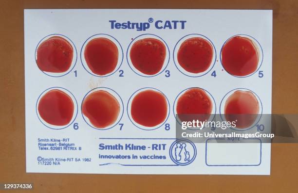 Blood Samples, Cote Divoire, Vicinity Daloa, Guediboua Village, Blood Samples Being Tested Using A Chemical Agent Which Indicates Blood Infected With...