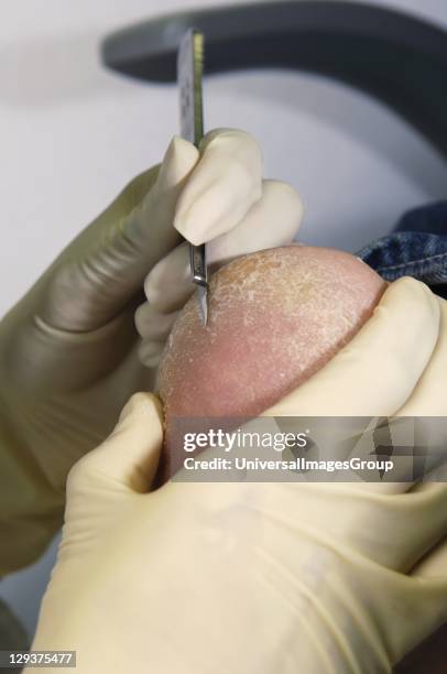 Podiatrist using scalpel to remove hardened and calloused skin from foot of patient