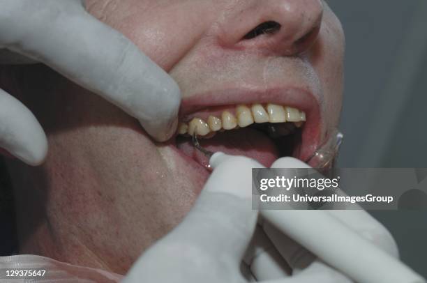 Dentist using dental scraper along with dental mirror to remove plaque from patients teeth