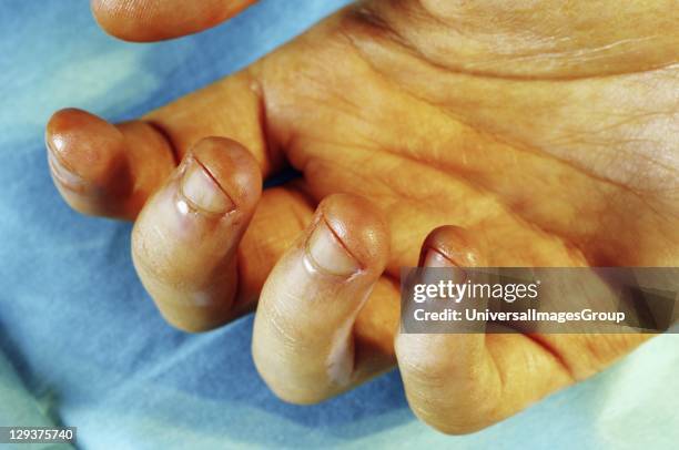 Hand swabbed with iodine before operation to kill organisms present on skin