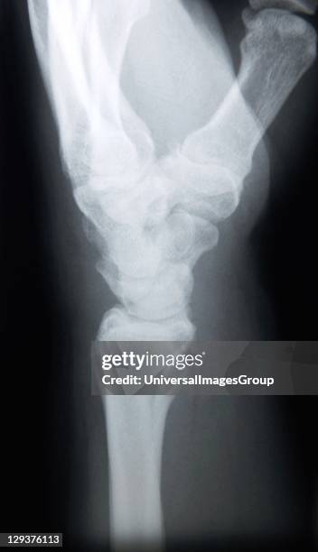 Ray image of female wrist