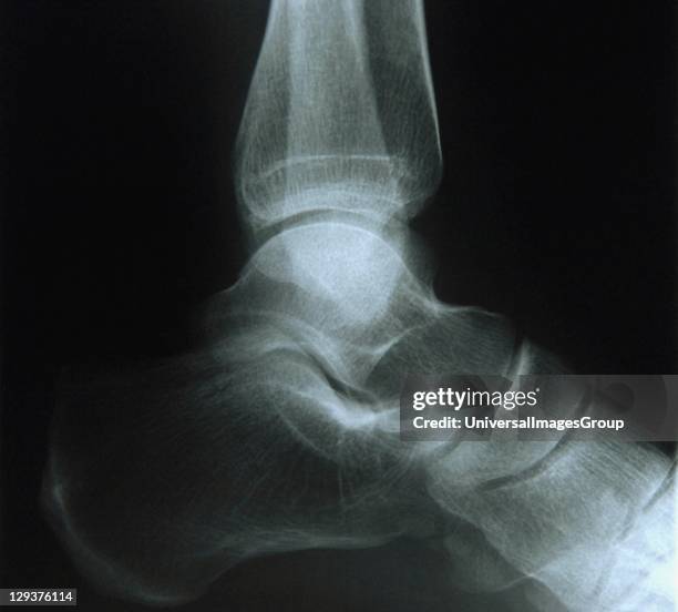 Ray image of female knee joint, with knee cap