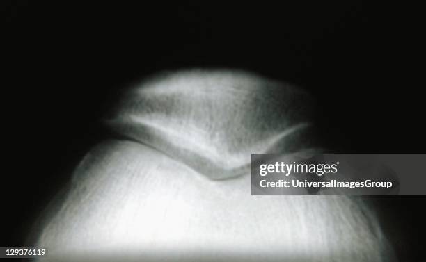 Ray image of female knee joint, with knee cap
