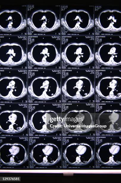 Scan image, Several sets of serial CT scans taken through the body. The radio-dense vertebrae can be seen towards the bottom of each individual scan....