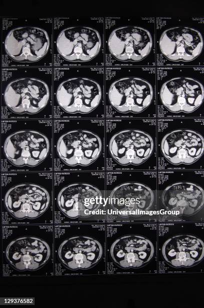 Scan image, Several sets of serial CT scans taken through the body. The radio-dense vertebrae can be seen towards the bottom of each individual scan....