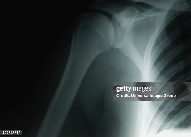 Ray image of female clavical, scapula and upper humerous