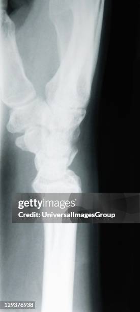 Ray image of female wrist