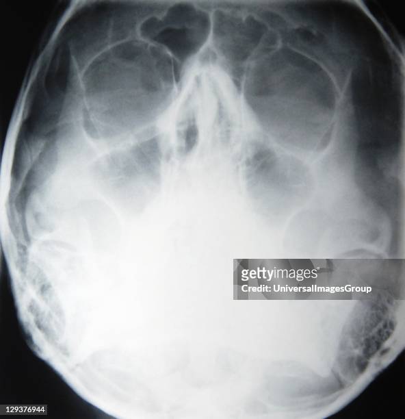 Ray image of skull