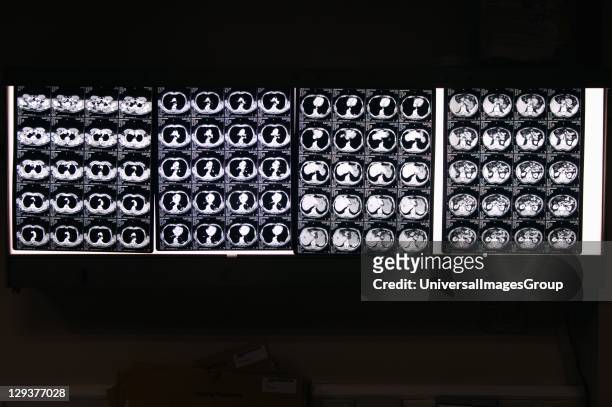 Scan images of human head, Several sets of serial CT scans taken through the body. The radio-dense vertebrae can be seen towards the bottom of each...