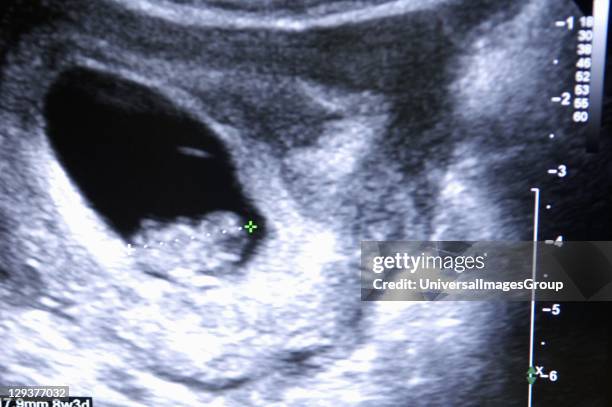 Ultrasound during pregnancy, An ultrasound scan of a foetus,centre left of the picture. A radiographer or sonographer uses special software to make...