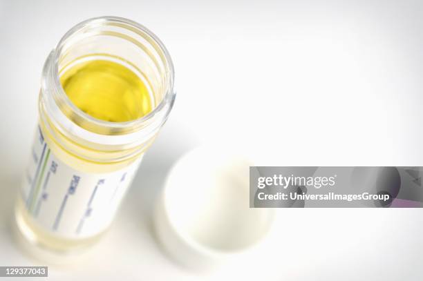 Urine Sample Example Patient Urine Sample Photos and Premium High Res Pictures - Getty Images
