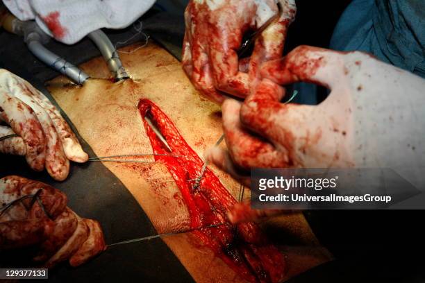 Surgeons stitching surgical wound