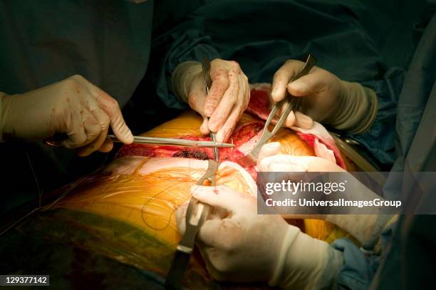 Surgeons stitching surgical wound during liver transplant operation