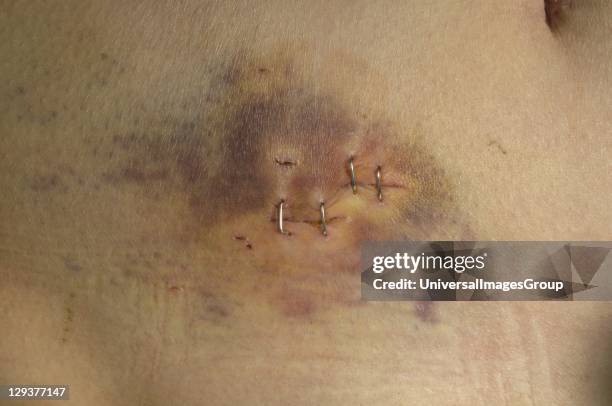 Knife wound and bruise of self harm victim, close-up