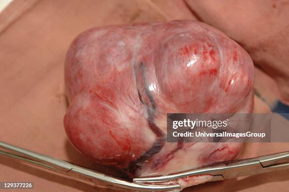 Surgeons operating to remove uterine fibroids Surgeons operating to remove uterine fibroids