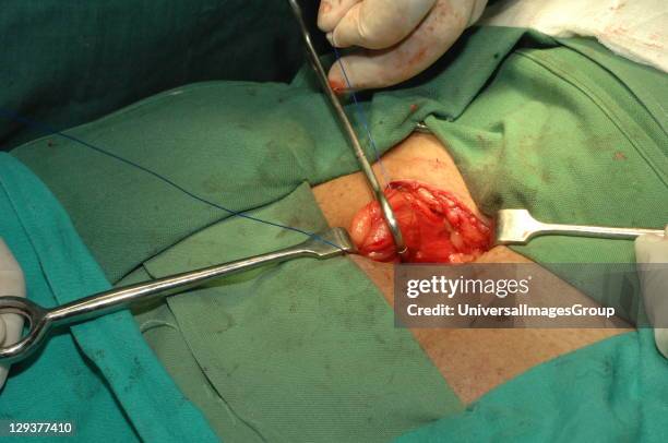 Surgeon repairing direct inguinal hernia on patient