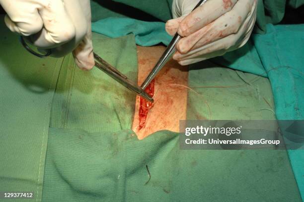 Surgeon closing the wound after repairing a direct inguinal hernia on patient