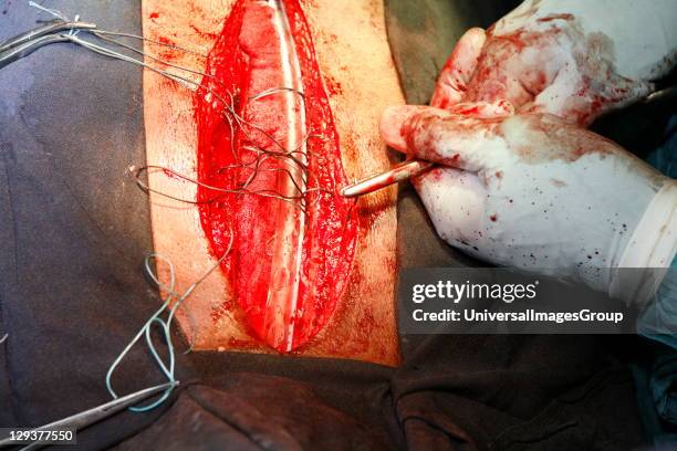 Surgeons stitching a surgical wound. Close-up