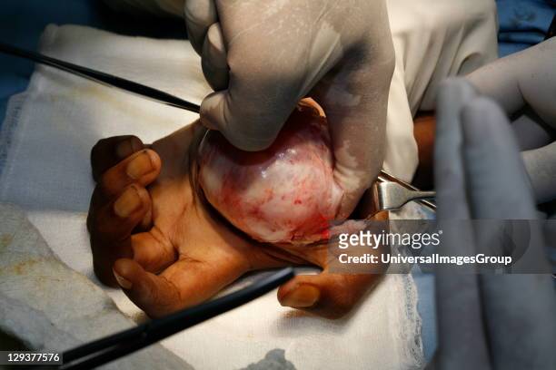 Surgeons operating to remove neurofibroma tumor from patient's hand