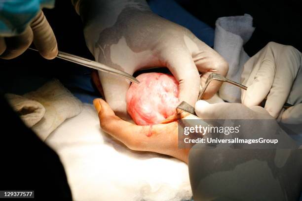 Surgeons operating to remove neurofibroma tumor from patient's hand