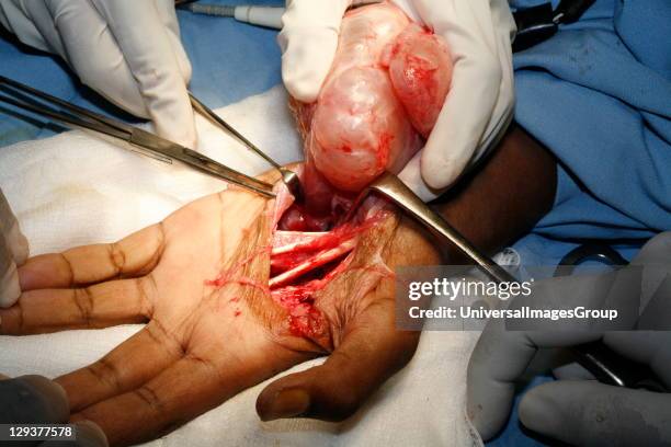 Surgeons cutting away connective tissue from neurofibroma tumor.