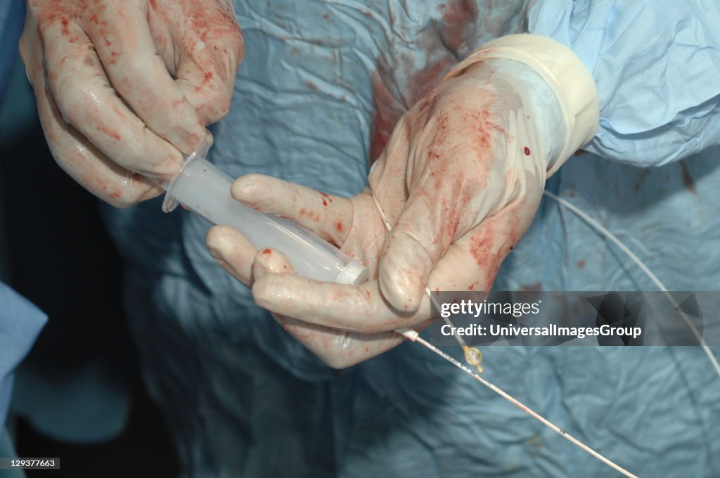 A surgeon deflates a balloon on a catheter before entering an artery during an embolectomy