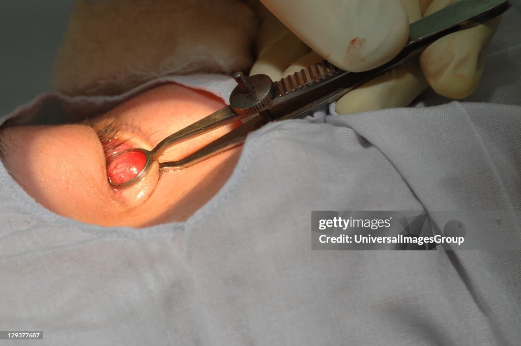 A surgeon uses surgical tools during an inverted eyelid operation. Close-up
