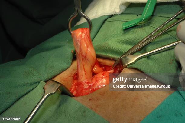 Surgeon repairing direct inguinal hernia on patient