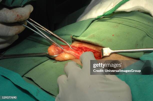 Surgeon repairing direct inguinal hernia on patient