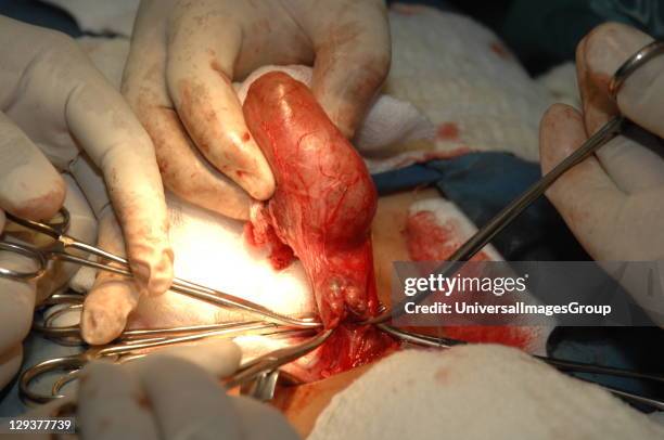 Surgeons removing goitre from patient