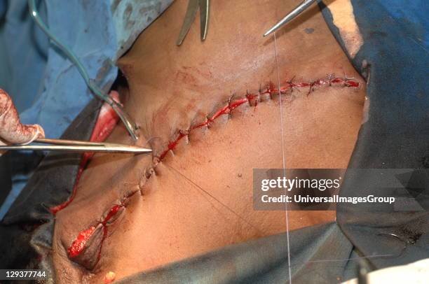 Skin closure by interrupted sutures, following a masectomy. Close-up