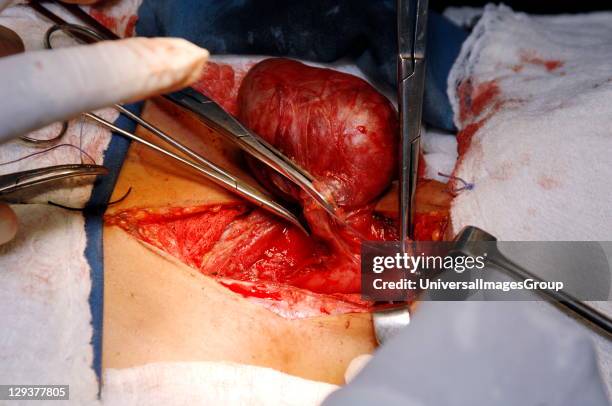 Thyroidectomy. Sudan, Africa., The lateral vessels are tied off with a silk ligature first.