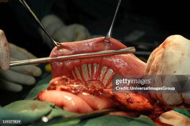 Straight soft bowel clamp used to occlude colon , This prevents any movement during the next part of operation.