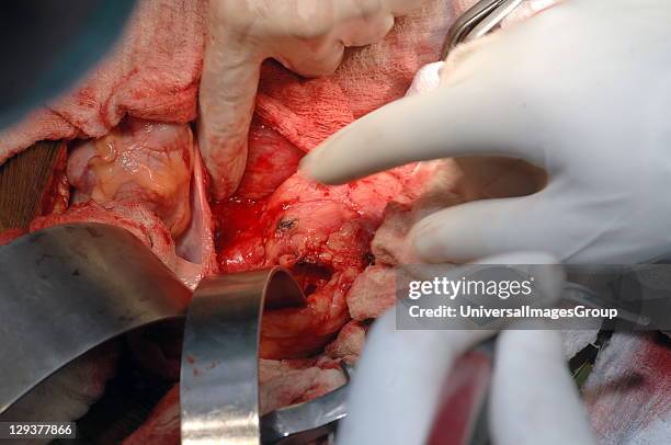 Surgeons open the aneurysmal sac